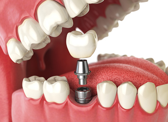 Dental Implants Anatomy