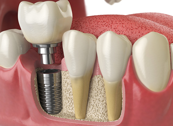 Dental Implants Cross Section View