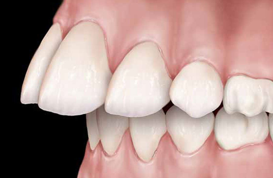 teeth protrusion