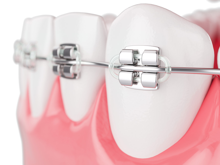 braces