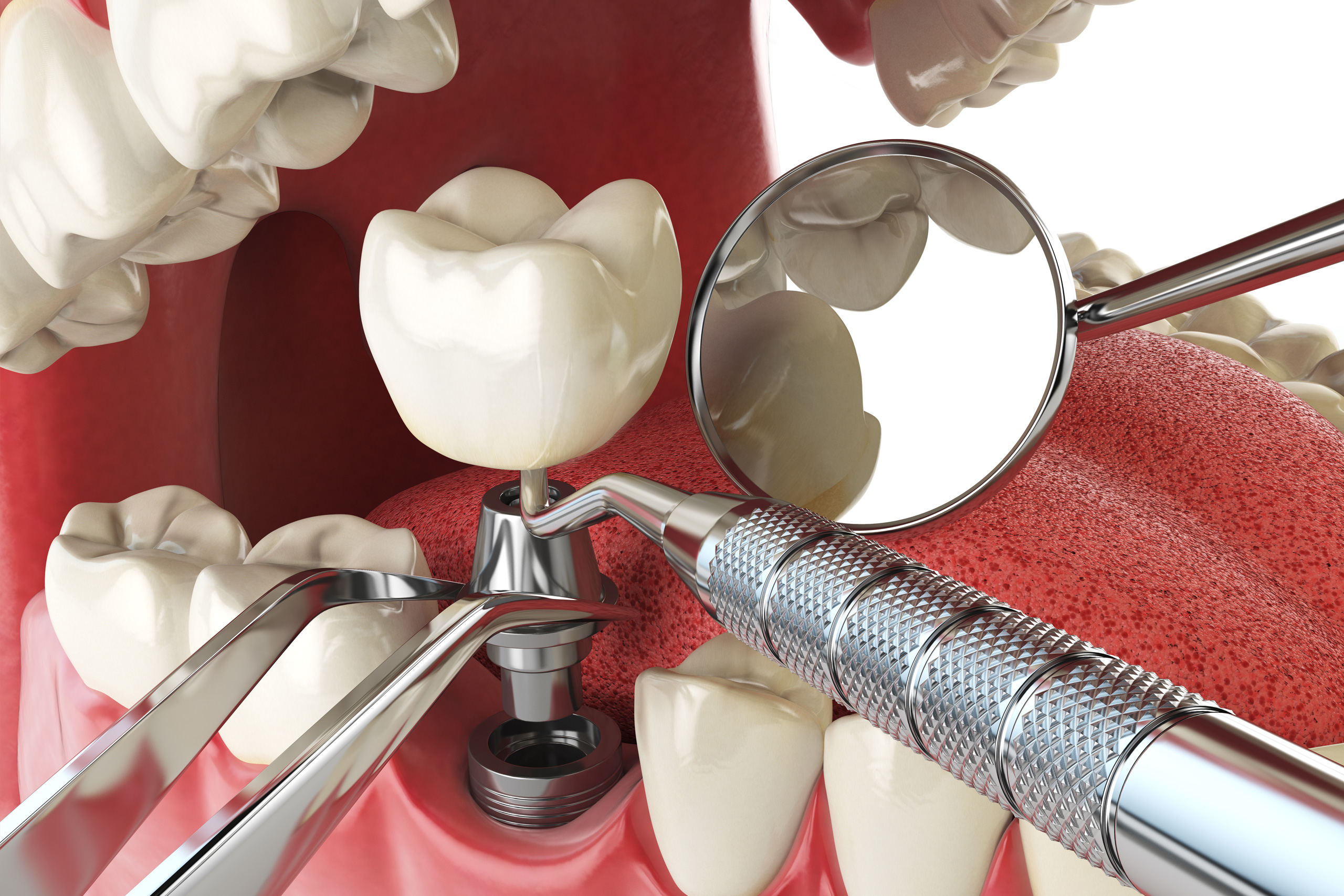 Types of Dental Implants Explained