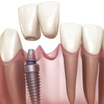 Front tooth implants
