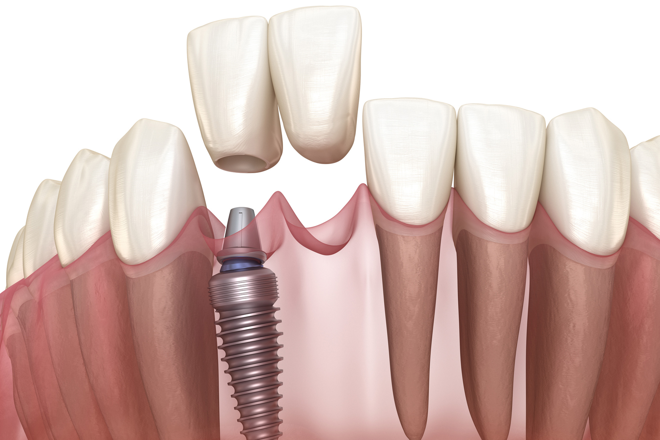 Front tooth implants